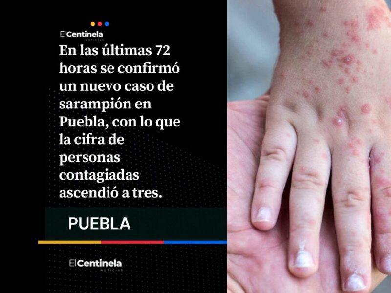 Alarmante aumento de sarampión en Puebla: ya son tres contagios confirmados