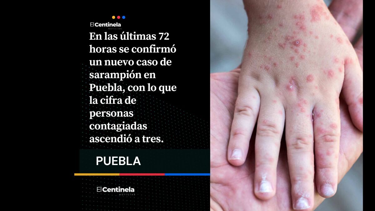 Alarmante aumento de sarampión en Puebla: ya son tres contagios confirmados