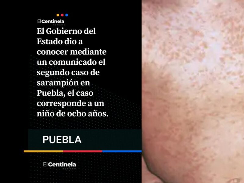Confirman segundo caso de sarampión en Puebla: se trata de un niño de 8 años