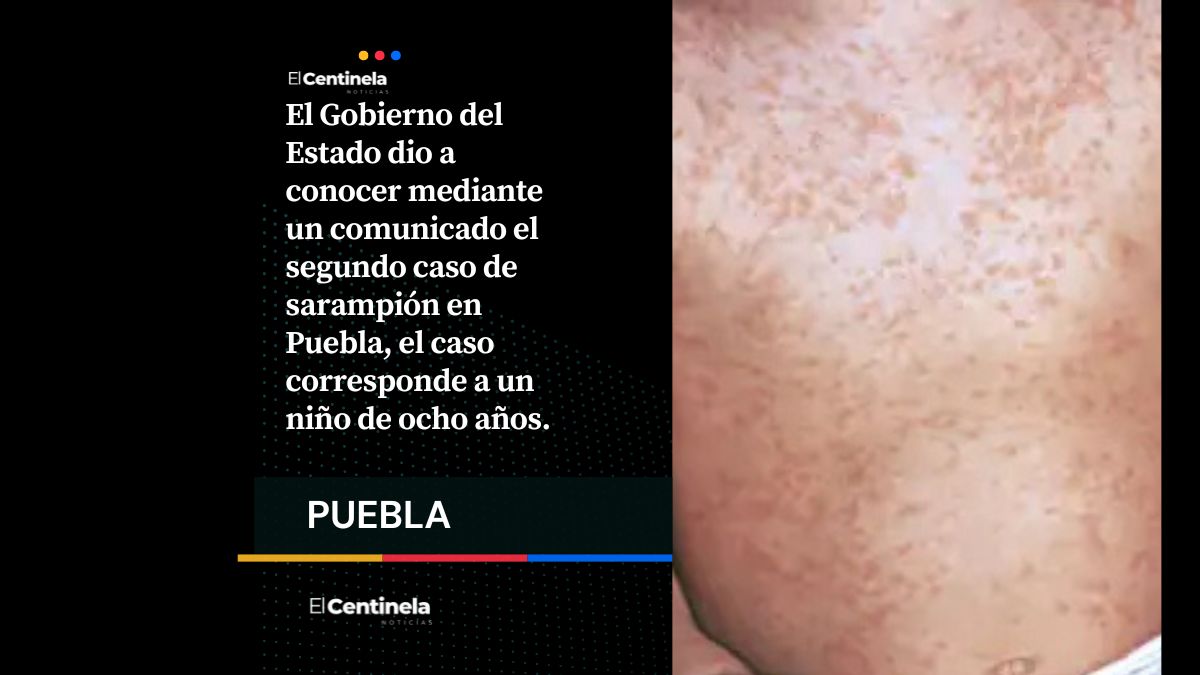 Confirman segundo caso de sarampión en Puebla: se trata de un niño de 8 años
