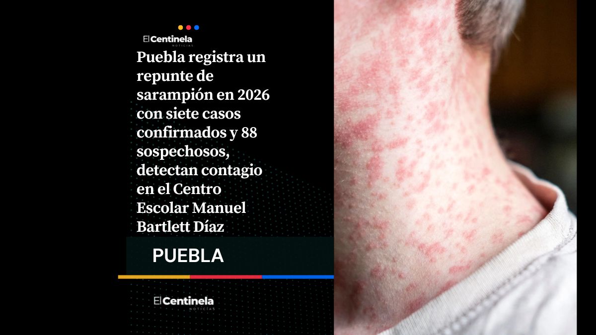 Sarampión se acelera en Puebla: confirman 7 casos y vigilan 88 sospechosos en una semana
