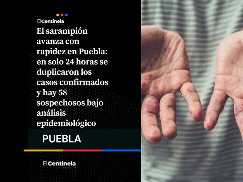 Detección de sarampión en Puebla se duplican en 24 horas: hay 16 contagios y 58 sospechosos