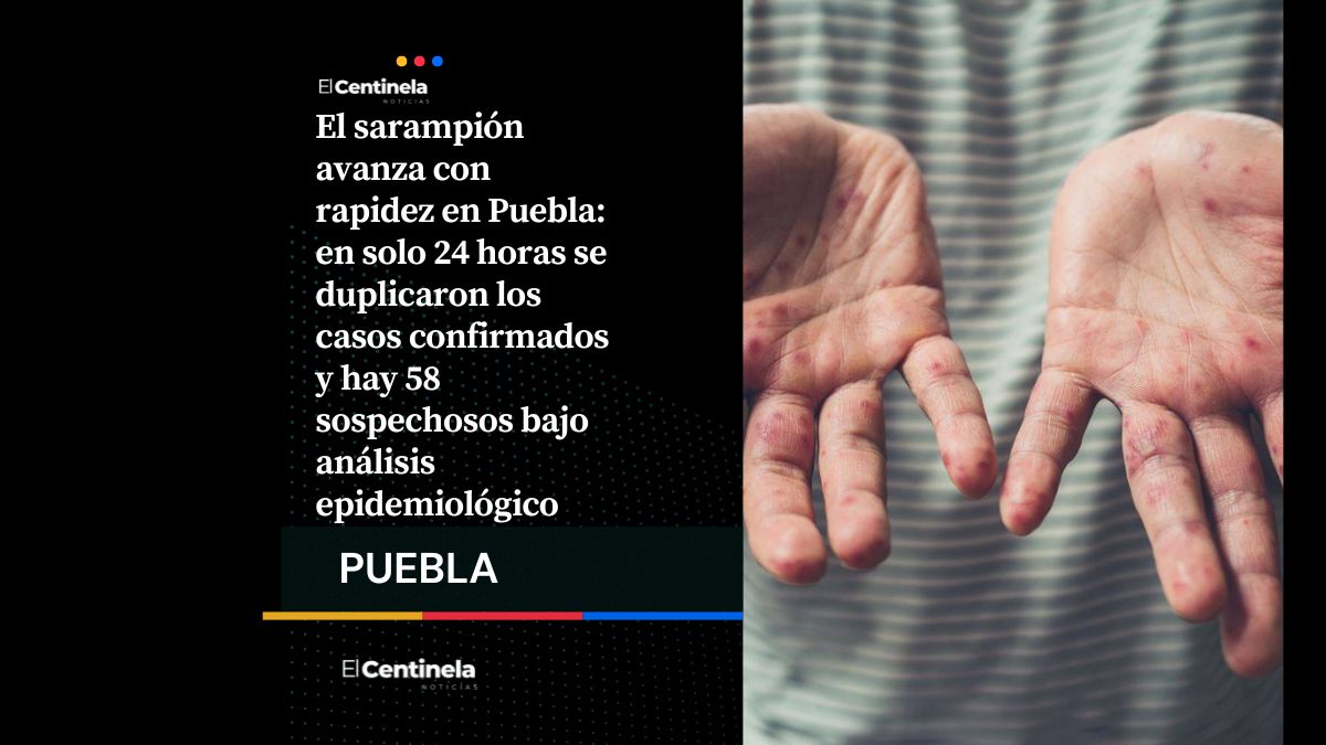Detección de sarampión en Puebla se duplican en 24 horas: hay 16 contagios y 58 sospechosos
