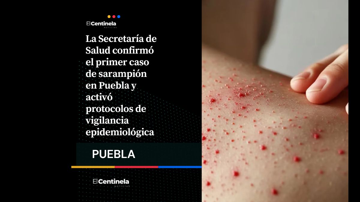 Confirman primer caso de sarampión en Puebla y activan protocolos sanitarios