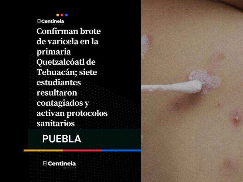 Brote de varicela en primaria de Tehuacán inicia alerta, hay siete alumnos contagiados