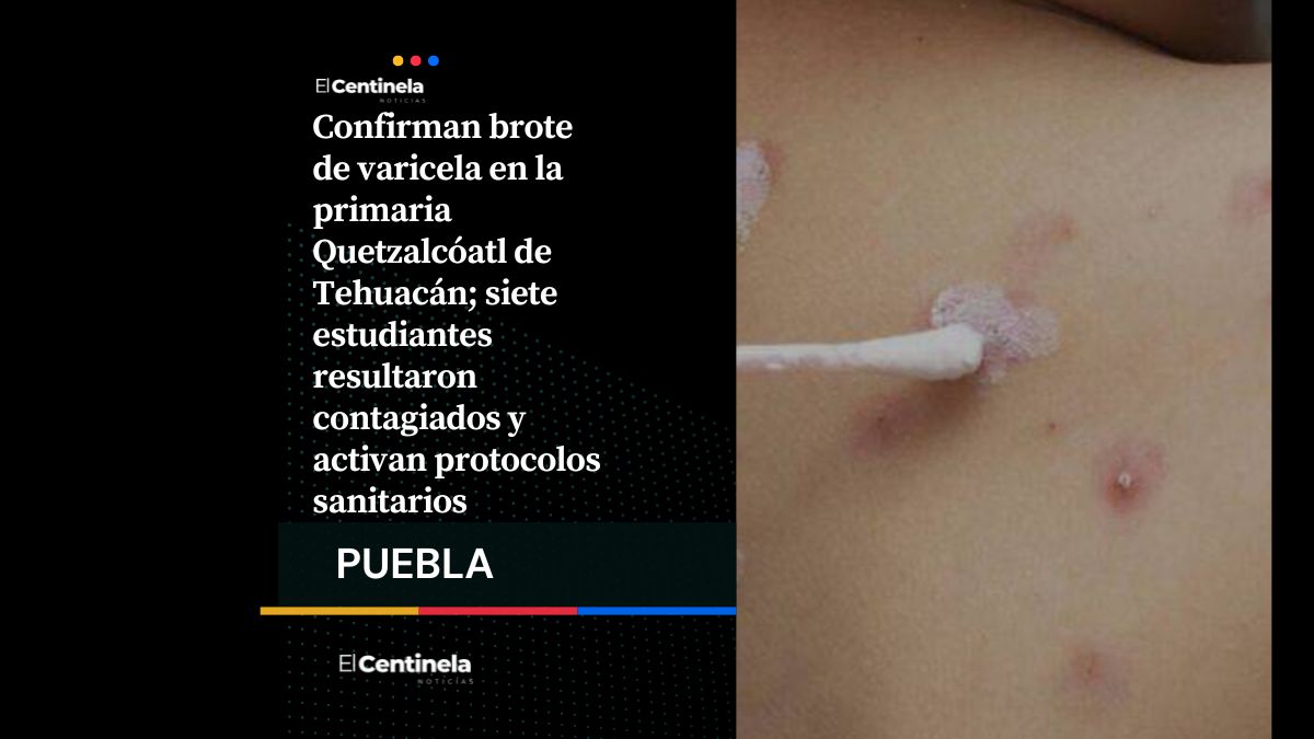 Brote de varicela en primaria de Tehuacán inicia alerta, hay siete alumnos contagiados