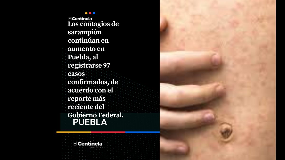 Puebla registra 97 contagios de sarampión y la cifra sigue en aumento