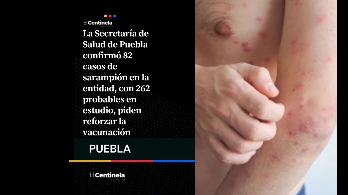 Brote de sarampión sigue creciendo en Puebla: sube a 82 casos en nueve municipios