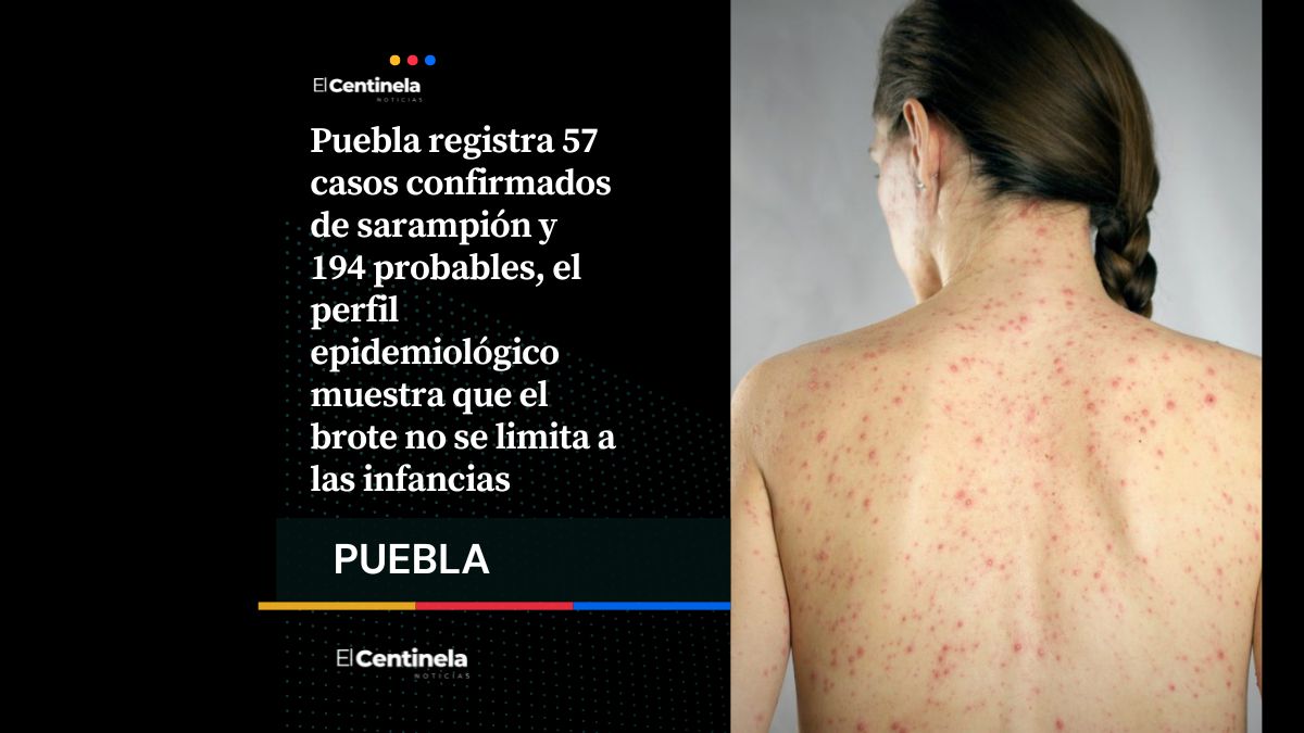 Aumenta presencia de sarampión en Puebla: suman 57 casos en 6 municipios