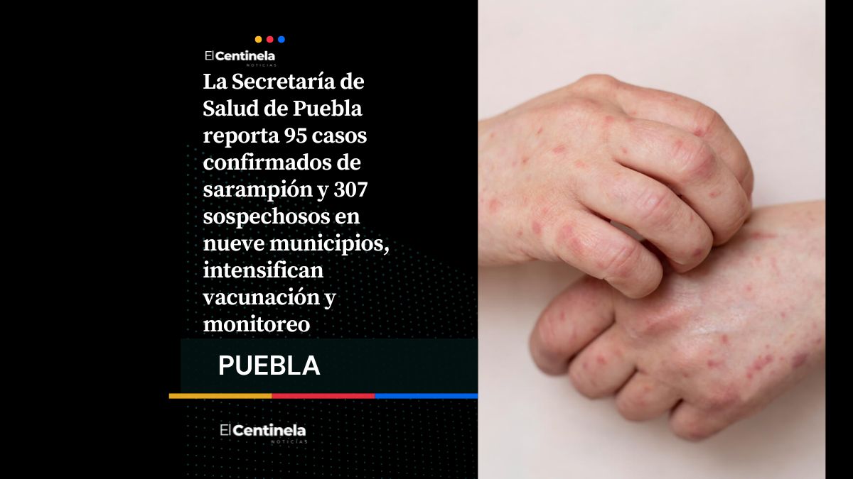 Brote de sarampión en Puebla continúa en aumento 95 casos confirmados y 307 sospechosos