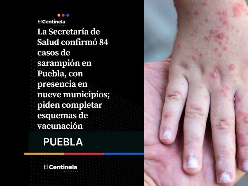 A la alta el sarampión en Puebla: confirman 84 casos y refuerzan llamado a vacunarse
