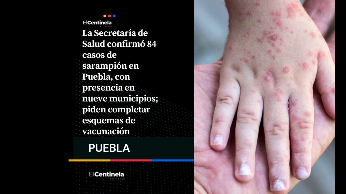 A la alta el sarampión en Puebla: confirman 84 casos y refuerzan llamado a vacunarse