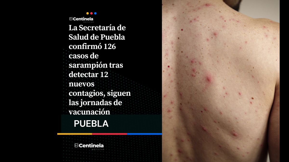 Casos de sarampión en Puebla aumentan a 126, Salud confirma 12 nuevos contagios en el estado