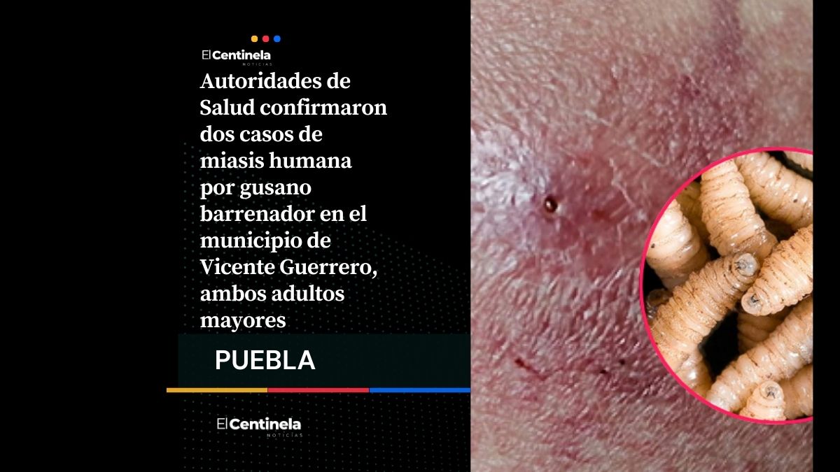 Salud Puebla confirma dos casos de gusano barrenador, pacientes están hospitalizados