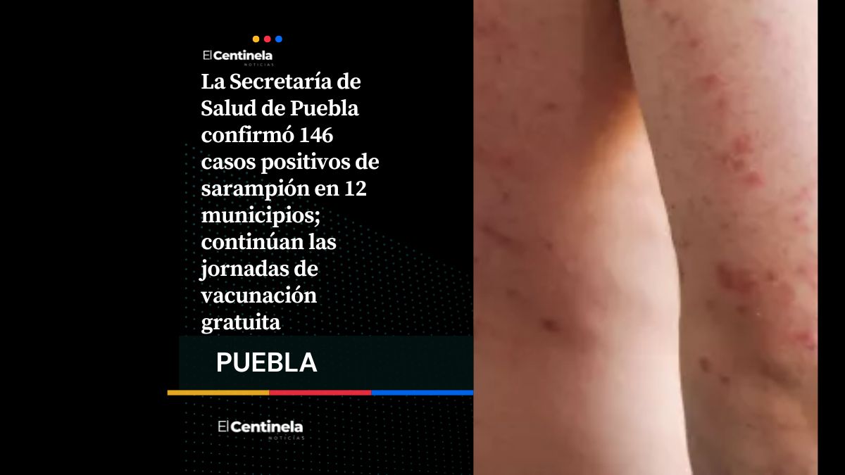 Puebla alcanza 146 casos activos de sarampión, reportan nuevo contagio este 4 de marzo