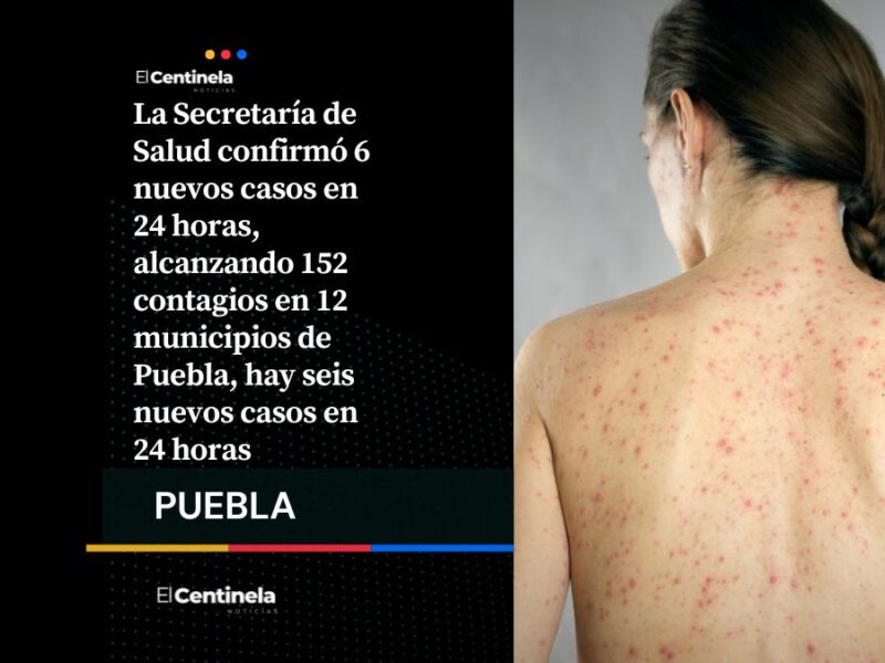 Sarampión avanza en Puebla: reportan 6 nuevos contagios y suman 152 casos confirmados