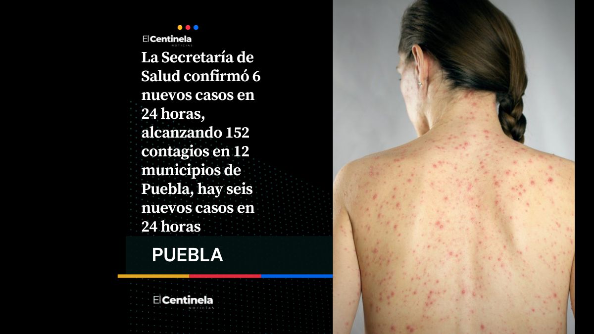 Sarampión avanza en Puebla: reportan 6 nuevos contagios y suman 152 casos confirmados
