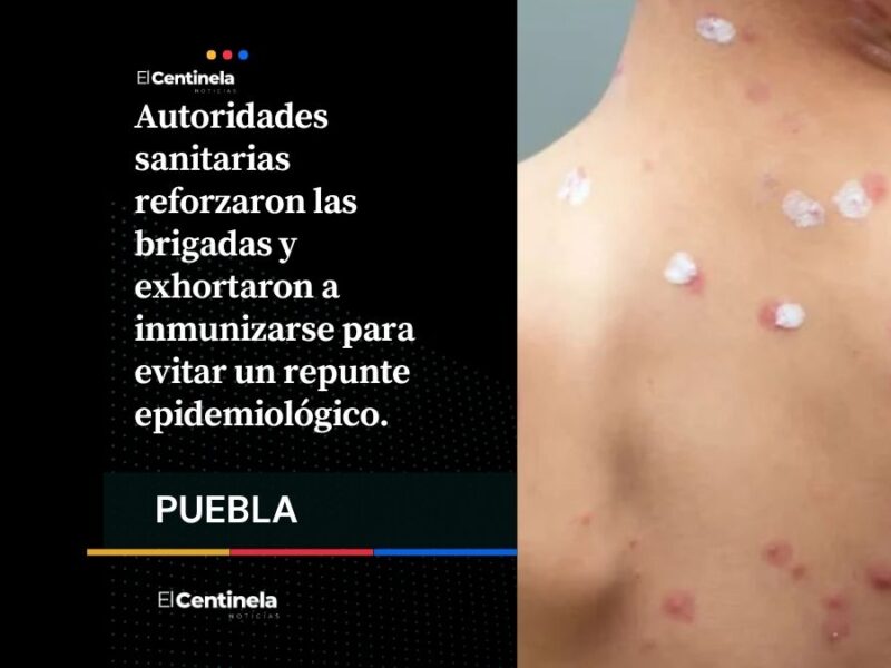 35 casos activos de sarampión