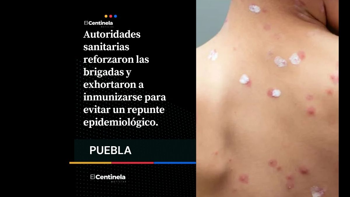 35 casos activos de sarampión